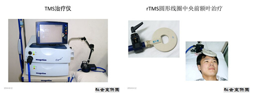 rTMS治疗抑郁症的技术优化研究系列报道之四 --研究结果